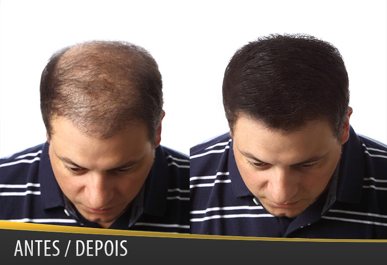 SHAMPOO CONTRA QUEDA DE CABELOS E TRATAMENTO PARA CALVÍCIE SHAMPOO CONTRA QUEDA DE CABELOS E TRATAMENTO PARA CALVÍCIE